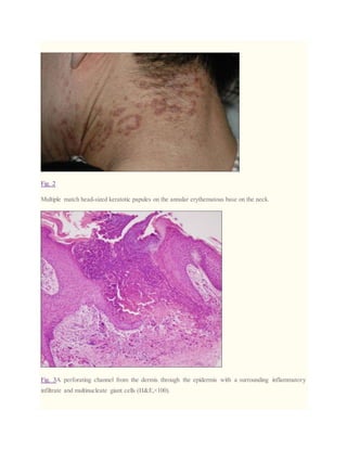 Fig. 2
Multiple match head-sized keratotic papules on the annular erythematous base on the neck.
Fig. 3A perforating channel from the dermis through the epidermis with a surrounding inflammatory
infiltrate and multinucleate giant cells (H&E,×100).
 
