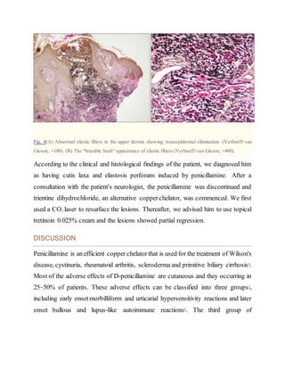 Fig. 4(A) Abnormal elastic fibers in the upper dermis showing transepidermal elimination (Verhoeff-van
Gieson, ×100). (B) The "bramble bush" appearance of elastic fibers (Verhoeff-van Gieson, ×400).
According to the clinical and histological findings of the patient, we diagnosed him
as having cutis laxa and elastosis perforans induced by penicillamine. After a
consultation with the patient's neurologist, the penicillamine was discontinued and
trientine dihydrochloride, an alternative copperchelator, was commenced. We first
used a CO2 laser to resurface the lesions. Thereafter, we advised him to use topical
tretinoin 0.025% cream and the lesions showed partial regression.
DISCUSSION
Penicillamine is an efficient copper chelatorthat is used for the treatment of Wilson's
disease, cystinuria, rheumatoid arthritis, scleroderma and primitive biliary cirrhosis8
.
Most of the adverse effects of D-penicillamine are cutaneous and they occurring in
25~50% of patients. These adverse effects can be classified into three groups3
,
including early onsetmorbilliform and urticarial hypersensitivity reactions and later
onset bullous and lupus-like autoimmune reactions9
. The third group of
 