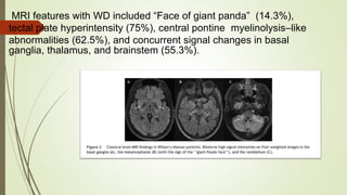 MRI features with WD included “Face of giant panda” (14.3%),
tectal plate hyperintensity (75%), central pontine myelinolysis–like
abnormalities (62.5%), and concurrent signal changes in basal
ganglia, thalamus, and brainstem (55.3%).
 