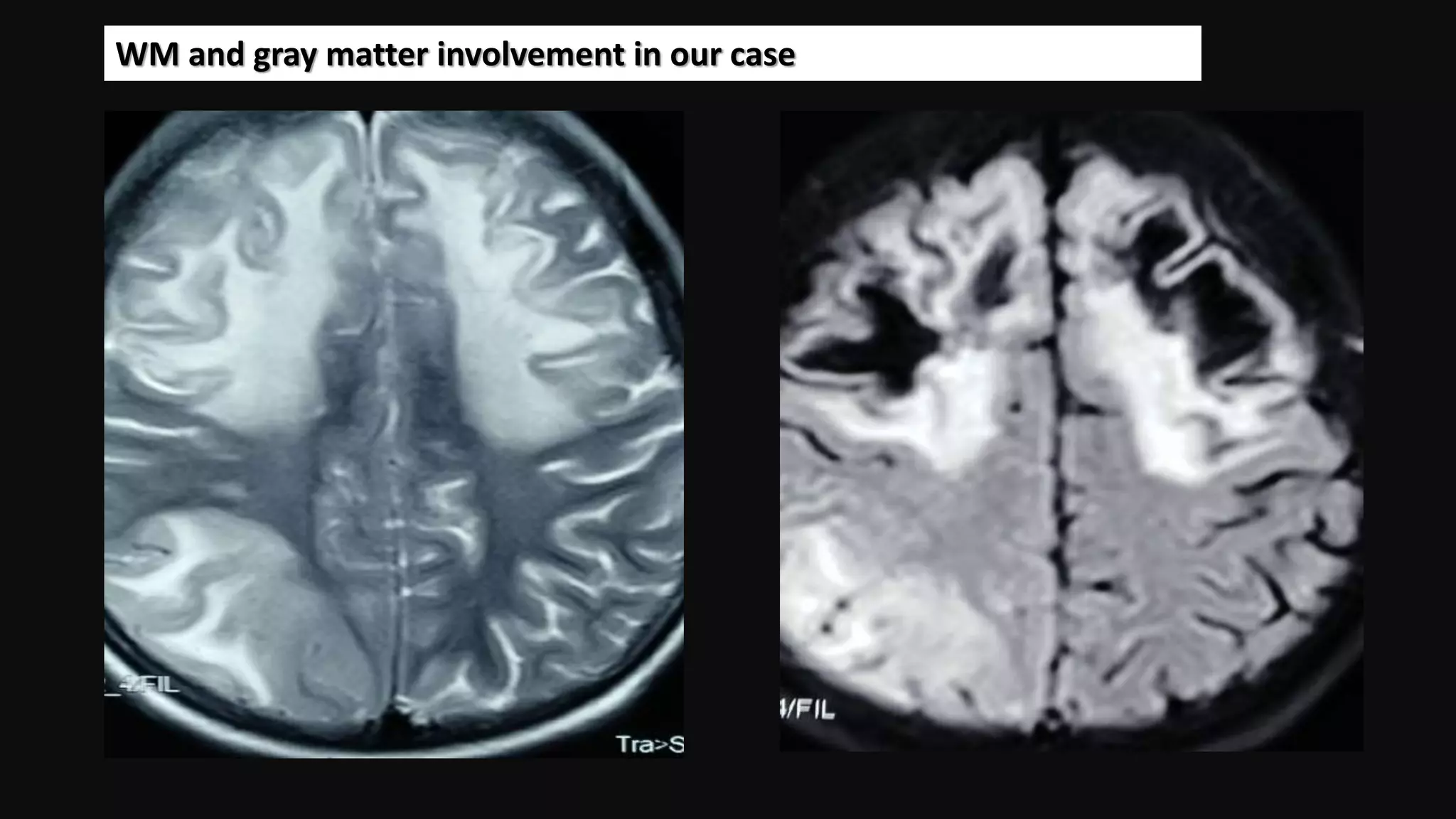 Extensive gray and white matter abnormality of wilson's disease ...