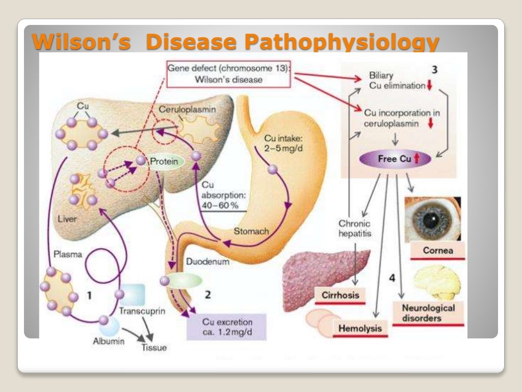 Wilson’s disease