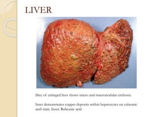 LIVER
Slice of enlarged liver shows micro and macronodular cirrhosis.
Inset demonstrates copper deposits within hepatocytes on rubeanic
acid stain. Inset: Rubeanic acid
 