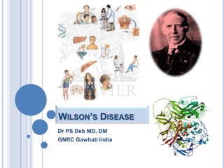 Wilson’s Disease Dr PS Deb MD, DM GNRC Gawhati India 