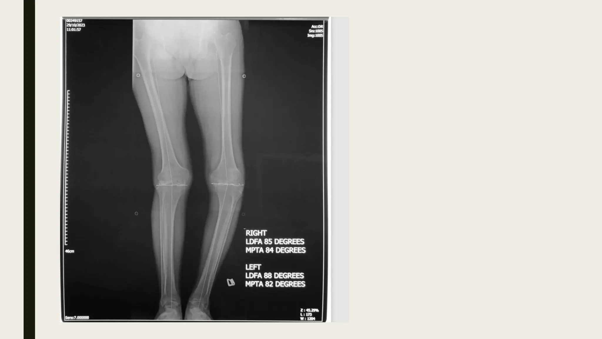 Right Windswept Pattern windswept deformity in total knee replacement .pptx