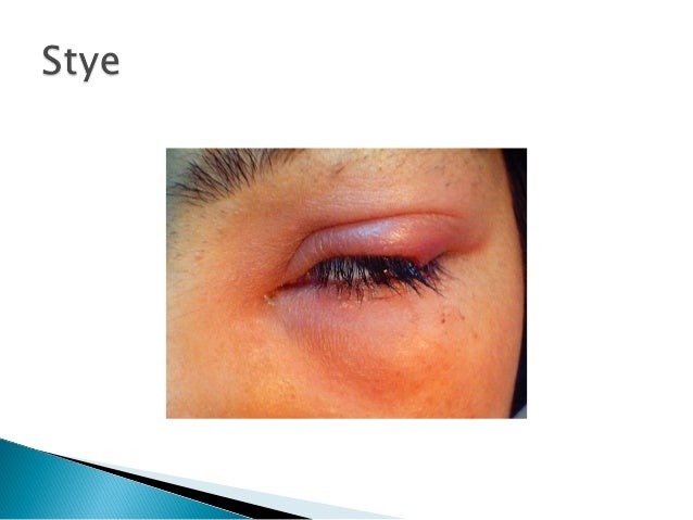 Common eye conditions