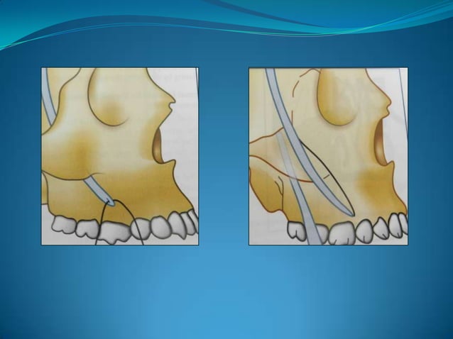 Wiring techniques in maxillofacial surgery | PPT