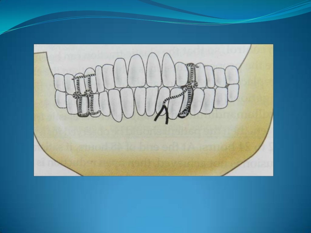 Wiring techniques in maxillofacial surgery