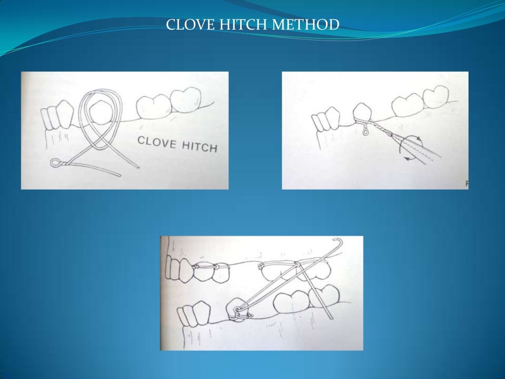 Wiring techniques in maxillofacial surgery