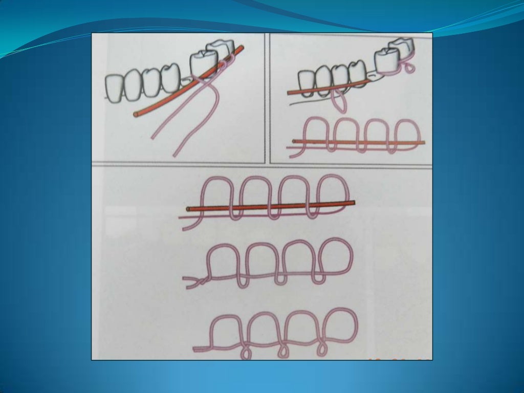 Wiring techniques in maxillofacial surgery