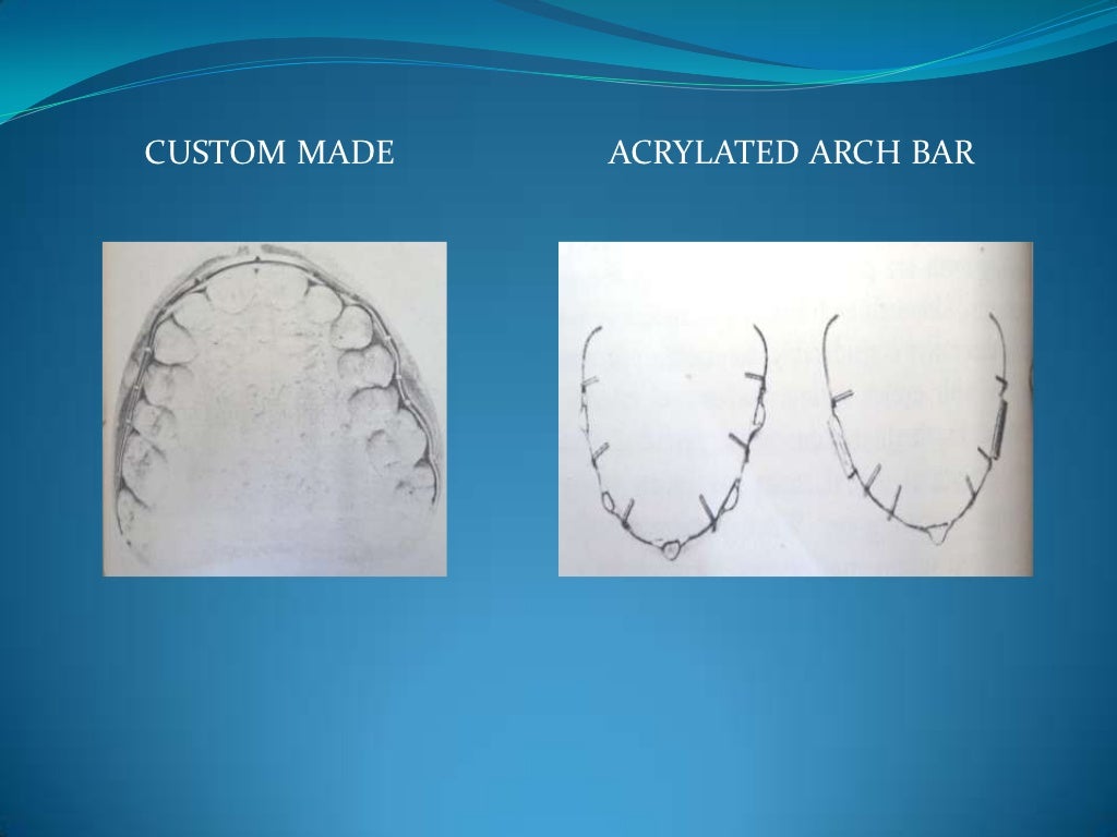 Wiring techniques in maxillofacial surgery
