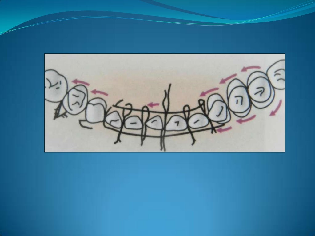 Wiring techniques in maxillofacial surgery