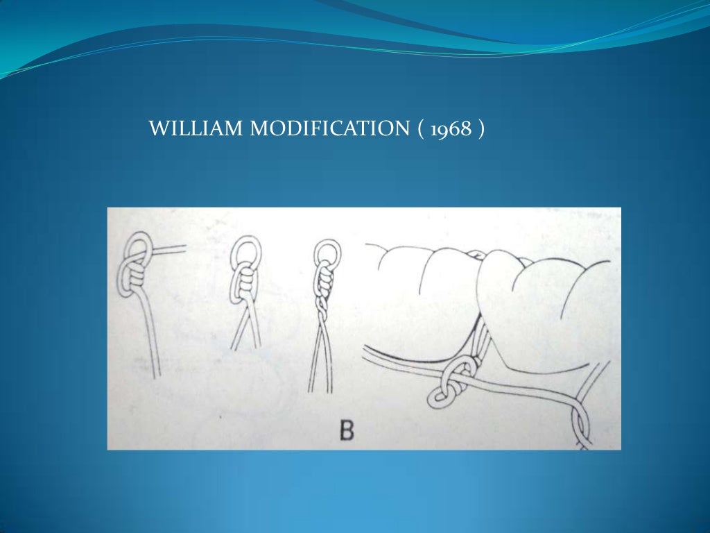 Wiring techniques in maxillofacial surgery