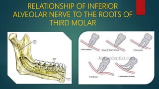 RELATIONSHIP OF INFERIOR
ALVEOLAR NERVE TO THE ROOTS OF
THIRD MOLAR
 