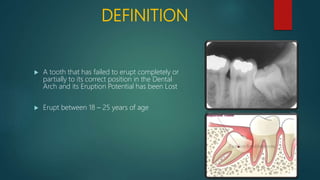 DEFINITION
 A tooth that has failed to erupt completely or
partially to its correct position in the Dental
Arch and its Eruption Potential has been Lost
 Erupt between 18 – 25 years of age
 