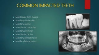 COMMON IMPACTED TEETH
 Mandibular third molars
 Maxillary third molar
 Maxillary canine
 Mandibular premolars
 Maxillary premolar
 Mandibular canine
 Maxillary central incisor
 Maxillary lateral incisor
 