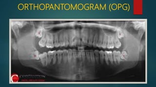 ORTHOPANTOMOGRAM (OPG)
 