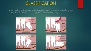 CLASSIFICATION
 According to Long axis of the impacted tooth in relation to the long axis
of the 2nd molar Winter’s classification (1926)
 