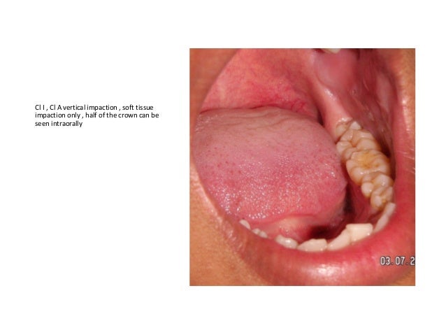 Wisdom Tooth Impaction Wisdom Tooth Impaction