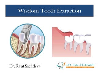 Wisdom Tooth Extraction
Dr. Rajat Sachdeva
 