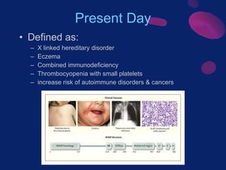 Present Day <ul><li>Defined as:  </li></ul><ul><ul><li>X linked hereditary disorder </li></ul></ul><ul><ul><li>Eczema </li...