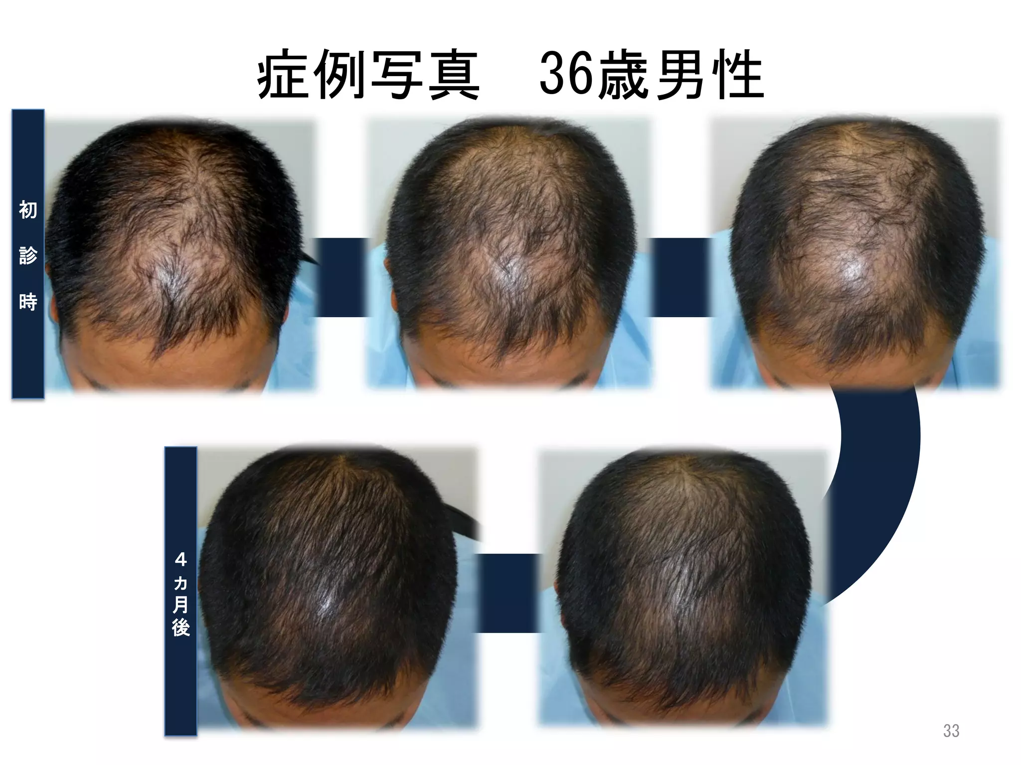 症例写真 36歳男性

初

診

時




    ４
    ヵ
    月
    後




                     33
 