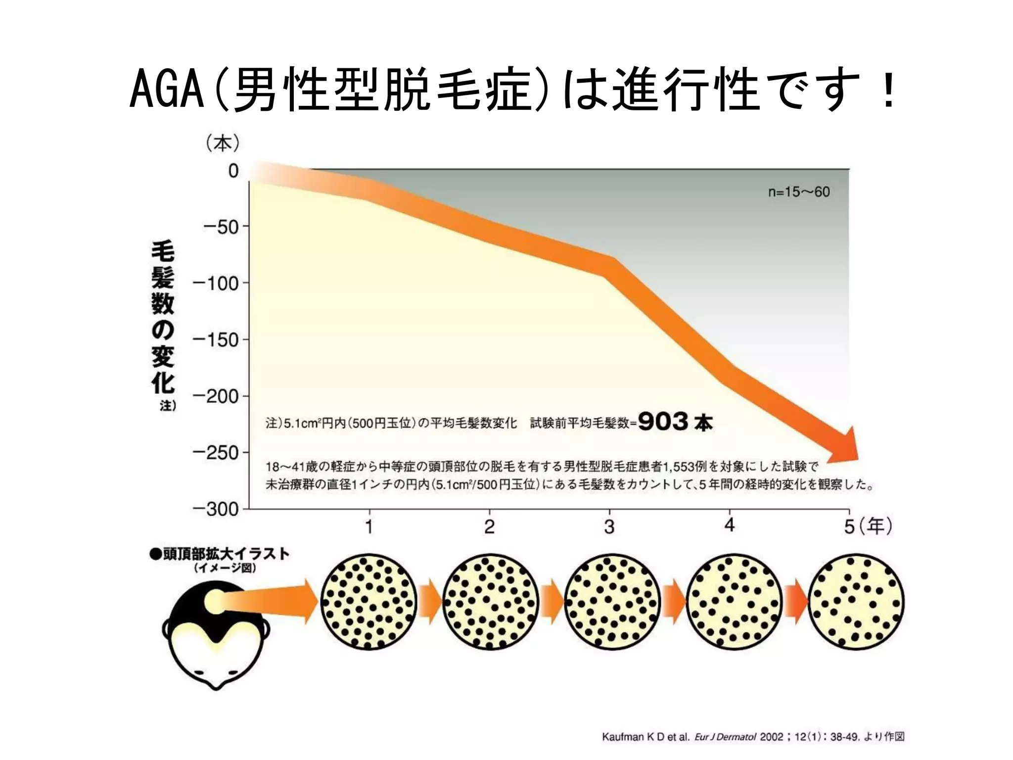 AGA(男性型脱毛症)は進行性です！
 