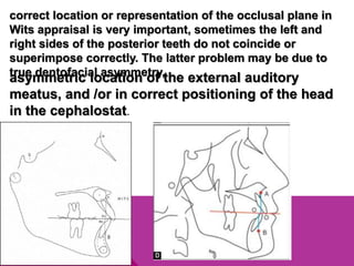 correct location or representation of the occlusal plane in
Wits appraisal is very important, sometimes the left and
right sides of the posterior teeth do not coincide or
superimpose correctly. The latter problem may be due to
true dentofacial asymmetry,
asymmetric location of the external auditory
meatus, and /or in correct positioning of the head
in the cephalostat.
 