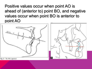 Positive values occur when point AO is
ahead of (anterior to) point BO, and negative
values occur when point BO is anterior to
point AO
 