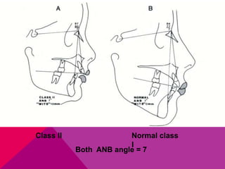 Both ANB angle = 7
Class II Normal class
I
 