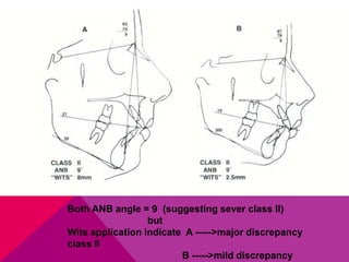 Both ANB angle = 9 (suggesting sever class II)
but
Wits application indicate A -----<major discrepancy
class II
B -----<mild discrepancy
 