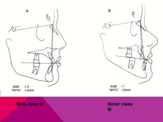Mild class III Sever class
III
 