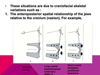 • These situations are due to craniofacial skeletal
variations such as :
1. The anteroposterior spatial relationship of the jaws
relative to the cranium (nasion). For example,
Standard
ANB=2
Long cranial
base(retroposit
ioned jaw)
Short cranial
base(jaws
positioned
forward to
 