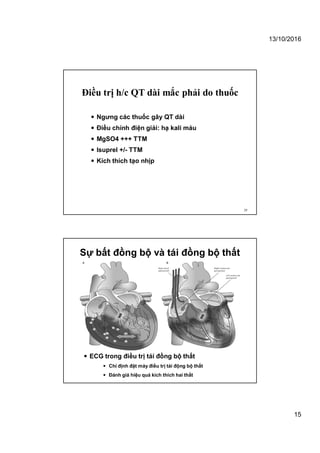 13/10/2016
15
Điều trị h/c QT dài mắc phải do thuốc
 Ngưng các thuốc gây QT dài
 Điều chỉnh điện giải: hạ kali máu
 MgSO4 +++ TTM
 Isuprel +/- TTM
 Kích thích tạo nhịp
29
Sự bất đồng bộ và tái đồng bộ thất
 ECG trong điều trị tái đồng bộ thất
 Chỉ định đặt máy điều trị tái động bộ thất
 Đánh giá hiệu quả kích thích hai thất
 
