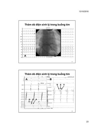 13/10/2016
23
Thăm dò điện sinh lý trong buồng tim
45
A B
Thăm dò điện sinh lý trong buồng tim
46
H A V
H V A
A B
 