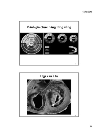 13/10/2016
44
Đánh giá chức năng từng vùng
87
Hẹp van 2 lá
Fish mouth
88
 
