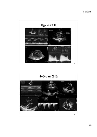 13/10/2016
45
Hẹp van 2 lá
89
Hở van 2 lá
90
 