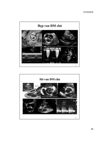 13/10/2016
46
Hẹp van ĐM chủ
91
Hở van ĐM chủ
92
 