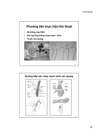 13/10/2016
59
Phương tiện thực hiện thủ thuật
117
 Hệ thống máy DSA
 Các loại ống thông chụp mạch vành
 Thuốc cản quang
Đường tiếp cận chụp mạch vành cản quang
118
 
