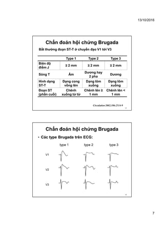 13/10/2016
7
Chẩn đoán hội chứng Brugada
Type 1 Type 2 Type 3
Biên độ
điểm J
≥ 2 mm ≥ 2 mm ≥ 2 mm
Sóng T Âm
Dương hay
2 pha
Dương
Hình dạng
ST-T
Dạng cong
vồng lên
Dạng lõm
xuống
Dạng lõm
xuống
Đoạn ST
(phần cuối)
Chênh
xuống từ từ
Chênh lên ≥
1 mm
Chênh lên <
1 mm
Bất thường đoạn ST-T ở chuyển đạo V1 tới V3
Circulation 2002;106:2514-9
13
Chẩn đoán hội chứng Brugada
• Các type Brugada trên ECG:
14
 