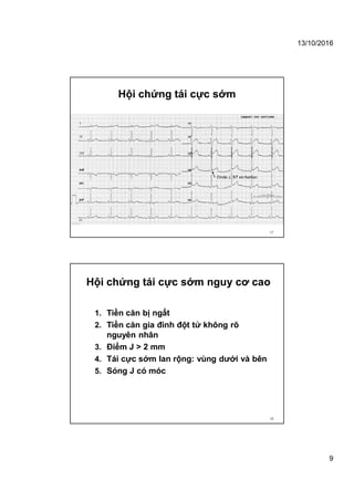 13/10/2016
9
Hội chứng tái cực sớm
17
Hội chứng tái cực sớm nguy cơ cao
1. Tiền căn bị ngất
2. Tiền căn gia đình đột tử không rõ
nguyên nhân
3. Điểm J > 2 mm
4. Tái cực sớm lan rộng: vùng dưới và bên
5. Sóng J có móc
18
 