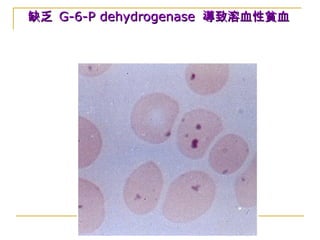 缺乏缺乏 G-6-P dehydrogenaseG-6-P dehydrogenase 導致溶血性貧血導致溶血性貧血
 