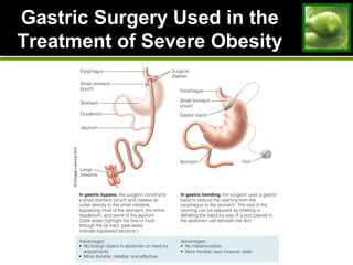 Gastric Surgery Used in theGastric Surgery Used in the
Treatment of Severe ObesityTreatment of Severe Obesity
 