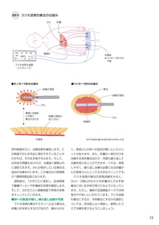 13
く、患者さんの体への負担が軽いというメリ
ットがあります。また、肝臓の一部分だけを
治療する局所療法なので、何度も繰り返して
治療を受けることができます。これは、再発
しやすく、繰り返し治療が必要になる肝臓が
んの患者さんにとっては大きなメリットです。
　ラジオ波焼灼療法の短期成績をみると、
3cm・3個以内の小さな肝臓がんでは手術
療法に近い生存率が得られるようになってい
ます。ただし、最新の全国調査データでは再
発がやや多いといわれています。ラジオ波焼
灼療法にするか、手術療法にするかの選択に
ついては、担当医とよく相談し、納得したう
えで治療を受けるようにしましょう。
MRI検査を行い、治療効果を確認します。こ
の検査でがんを完全に焼灼できていることが
わかれば、そのまま様子をみます。そして、
合併症の問題もなければ、治療後1週間以内
に退院できます。がんが残存している場合は、
追加の治療を行います。この場合は入院期間
が1週間程度延長になります。
　退院後は、1か月ごとに受診し、血液検査
で腫瘍マーカーや肝機能の状態を確認します。
そして、3か月ごとに画像検査で再発の有無
をチェックしていきます。
●体への負担が軽く、繰り返し治療が可能
　ラジオ波焼灼療法やエタノール注入療法は、
皮膚に針を刺入するだけなので、痛みも少な
ラジオ波焼灼療法の仕組み図表10
虎の門病院肝臓内科提供資料を参考に作成
●モノポーラ針の仕組み ●バイポーラ針の仕組み
肝臓
電極と対極板
との間で
電流が流れる
がん
ラジオ波発生装置
（ジェネレータ）
対極板　
＊バイポーラ針では
　不要
電極針
がん
がん
対極板
組織の凝固は
起こらない
組織の凝固
絶縁部
組織の凝固
電流
 