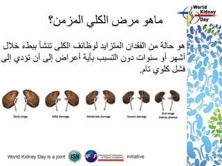 ‫ماهو‬‫المزمن؟‬ ‫الكلي‬ ‫مرض‬
‫خالل‬ ‫ببطء‬ ‫تنشأ‬ ‫الكلى‬ ‫لوظائف‬ ‫المتزايد‬ ‫الفقدان‬ ‫من‬ ‫حالة‬ ‫هو‬
‫إلى‬ ‫تؤدي‬ ‫أن‬ ‫إلى‬ ‫أعراض‬ ‫بأية‬ ‫التسبب‬ ‫دون‬ ‫سنوات‬ ‫أو‬ ‫أشهر‬
‫تام‬ ‫كلوي‬ ‫فشل‬.
 