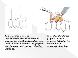Two releasing incisions
demarcate the area scheduled for
surgical therapy. A scalloped reverse
bevel incision is made in the gingival
margin to connect the two releasing
incisions.
The collar of inflamed
gingival tissue is
removed following the
elevation of a
mucoperiosteal flap.
 