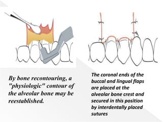 By bone recontouring, a
"physiologic" contour of
the alveolar bone may be
reestablished.
The coronal ends of the
buccal and lingual flaps
are placed at the
alveolar bone crest and
secured in this position
by interdentally placed
sutures
 