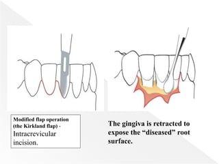 Modified flap operation
(the Kirkland flap) -
Intracrevicular
incision.
The gingiva is retracted to
expose the “diseased” root
surface.
 