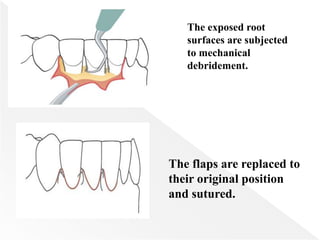 The exposed root
surfaces are subjected
to mechanical
debridement.
The flaps are replaced to
their original position
and sutured.
 