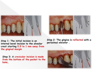 116
Step 1: The initial incision is an
internal bevel incision to the alveolar
crest starting 0.5 to 1 mm away from
the gingival margin
Step 2: The gingiva is reflected with a
periosteal elevator .
Step 3: A crevicular incision is made
from the bottom of the pocket to the
bone,
 