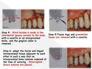 117
Step 4: third incision is made in the
interdental spaces coronal to the bone
with a curette or an interproximal
knife, and the gingival collar is
removed .
Step 5:Tissue tags and granulation
tissue are removed with a curette.
Step 6: adapt the facial and lingual
interproximal tissue adjacent to each
other in such a way that no
interproximal bone remains exposed at
the time of suturing . Interrupted
direct sutures are placed .
 